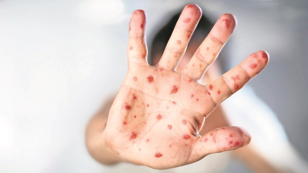 Nuevos casos de sarampión activan la alerta epidemiológica