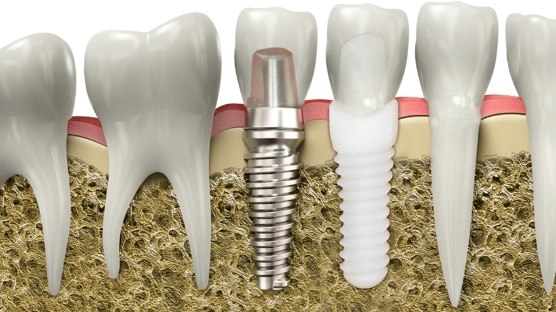 Implantes dentales: lo último en tecnología