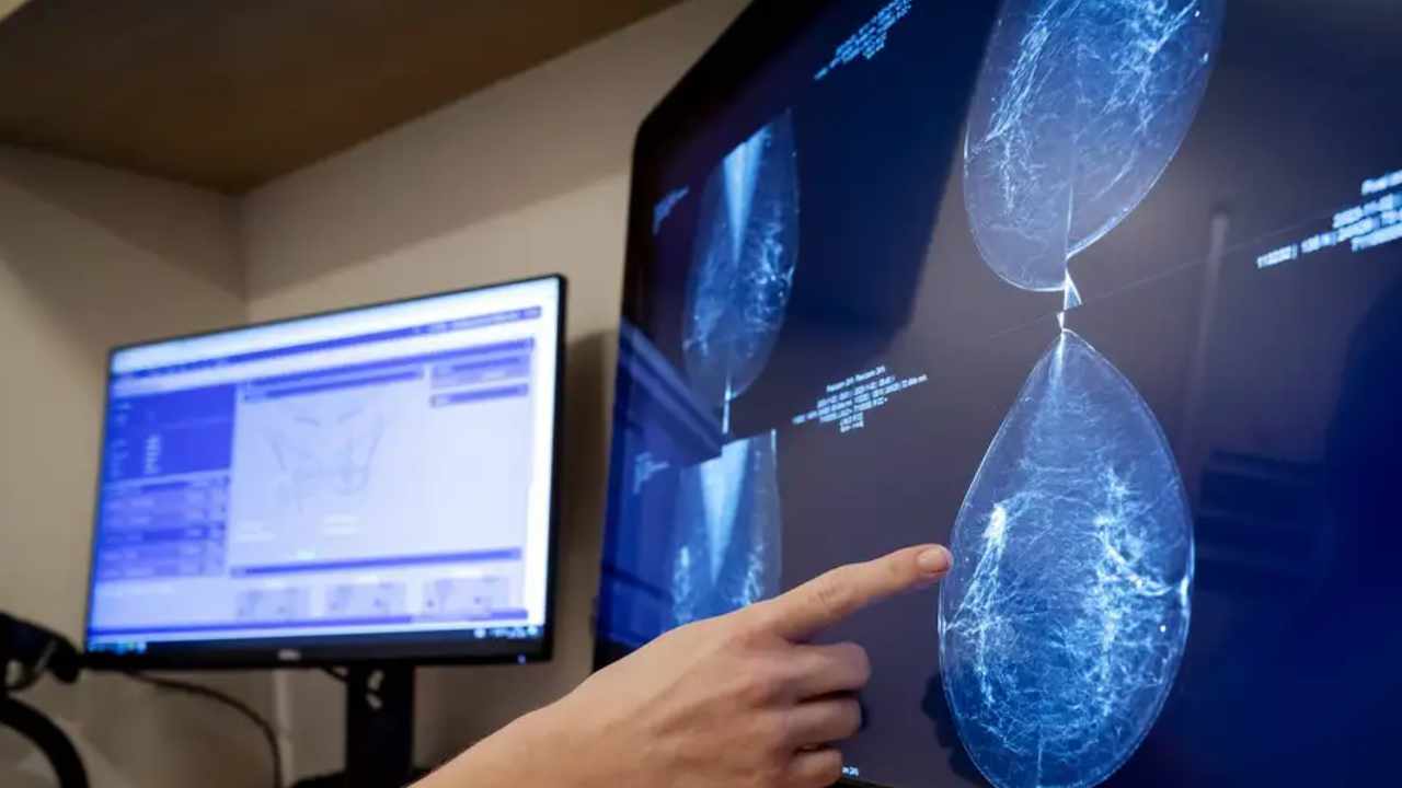 Cáncer de mama: la IA promete mejorar la detección precoz