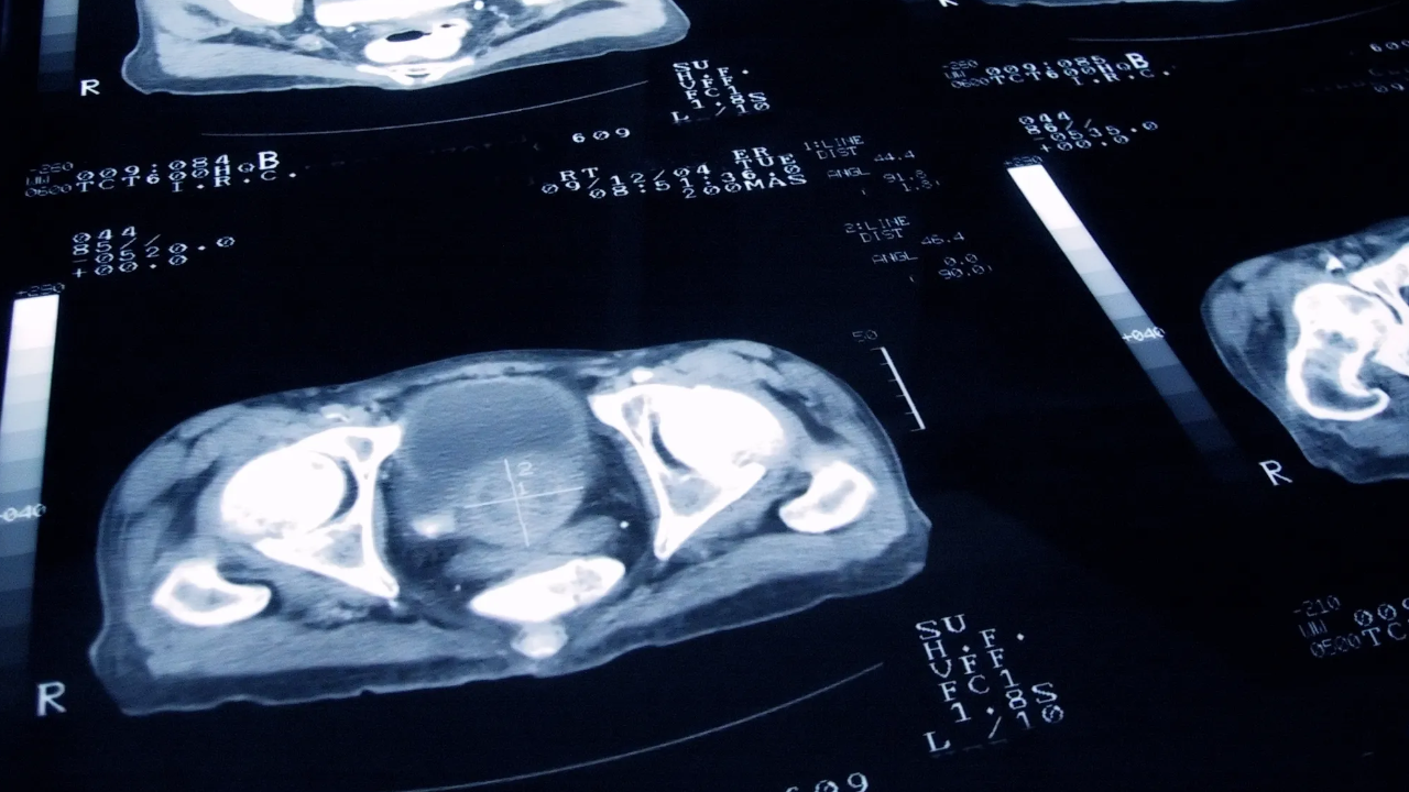 Cáncer de próstata: se registró un descenso de la mortalidad entre 2014 y 2024